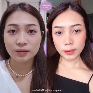 รีวิว-ลดกราม--แฟตแก้ม-แฟตเหนียง-3