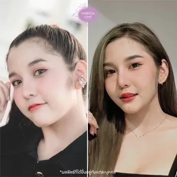 รีวิว-ลดกราม--แฟตแก้ม-แฟตเหนียง-4