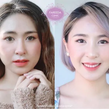 รีวิว-ลดกราม--แฟตแก้ม-แฟตเหนียง