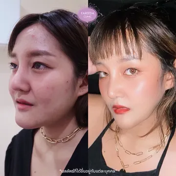 รีวิว-ลดกราม--แฟตแก้ม