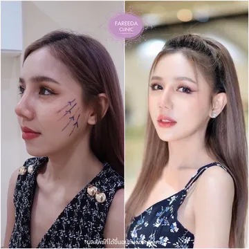 รีวิวร้อยไหม-เทคนิค-Tripple-Lock-ทริปเปิ้ลล็อค