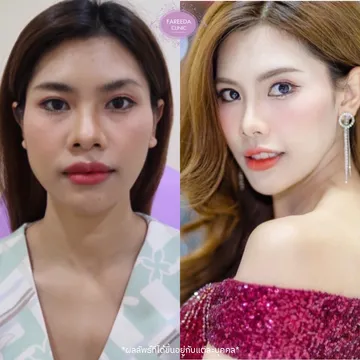 รีวิวลดกราม--ลิฟท์กรอบหน้า--แฟตแก้ม