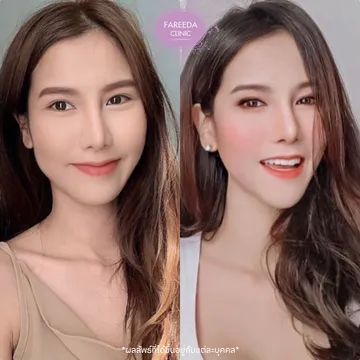 รีวิวไฮฟู-400-Shot-ยกแก้ม--เก็บกรอบหน้า