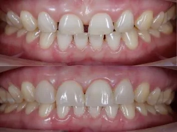 diastema3