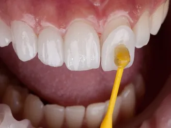 veneers(2)