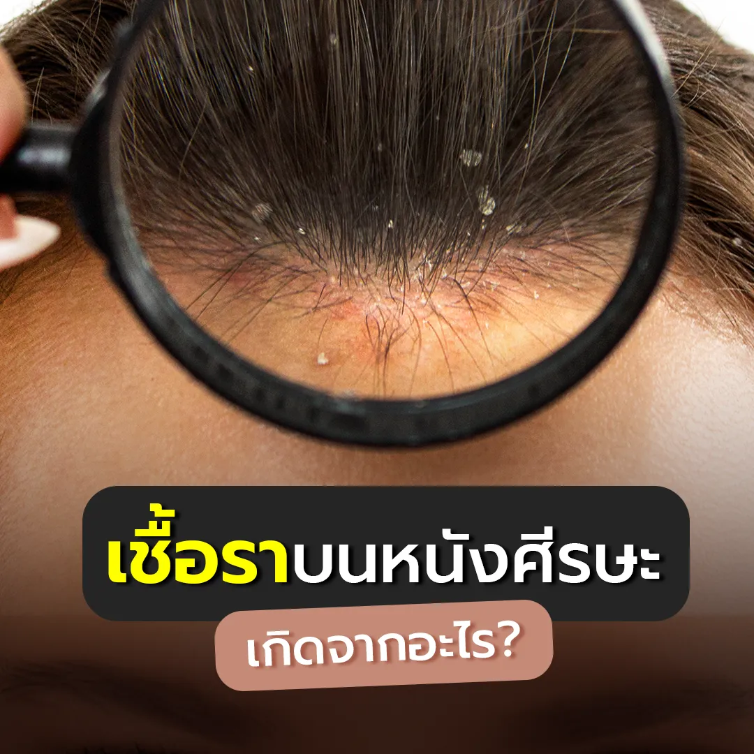 เชื้อราบนหนังศีรษะเกิดจากอะไรCover