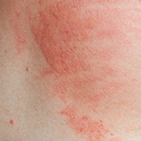 Itching-in-the-genital-area