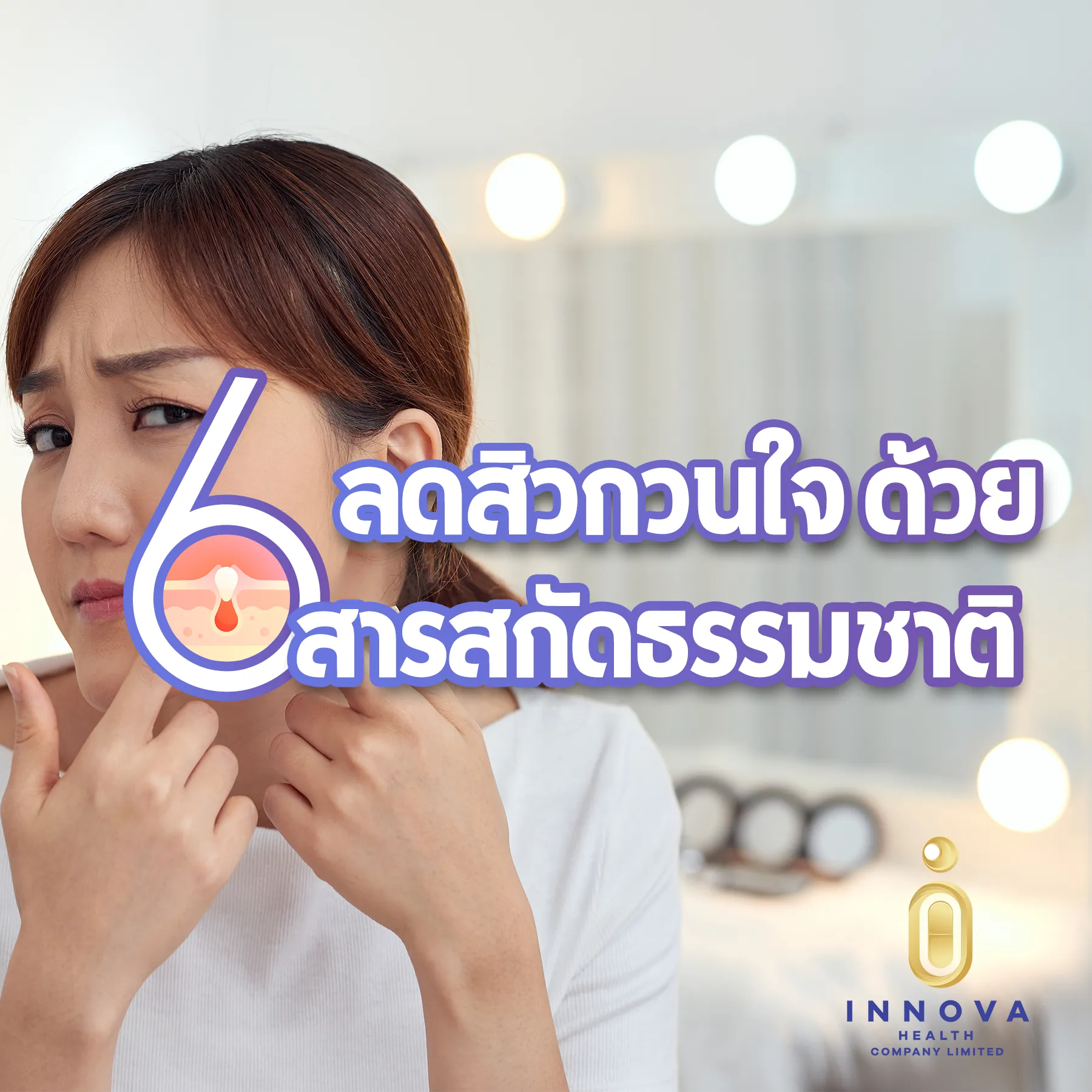 ลดสิวกวนใจ