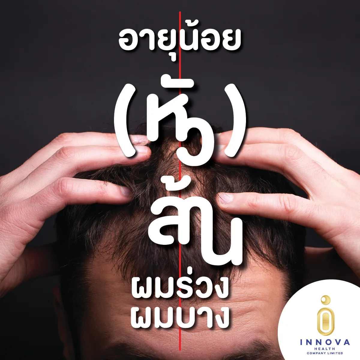 อายุน้อยร้อย(หัว)ล้านผมร่วงผมบางแก้ได้ด้