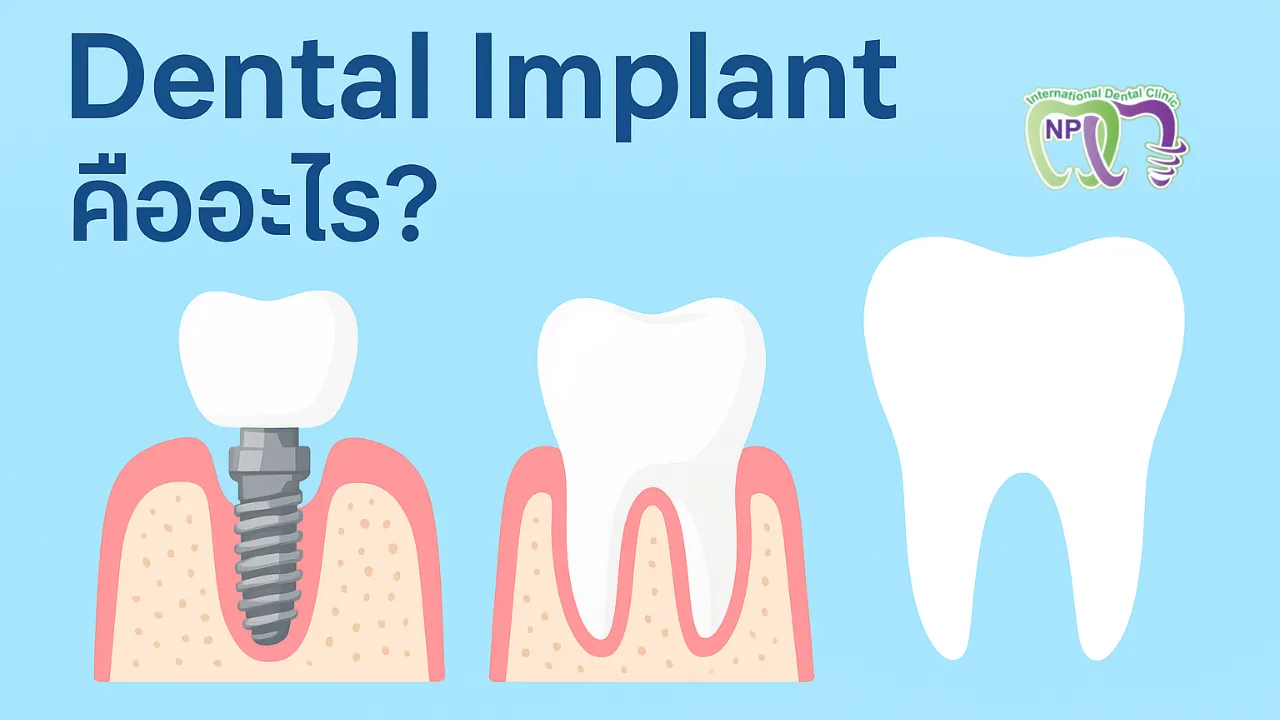 dentalimplantคือ