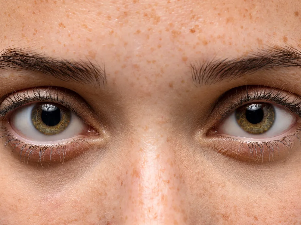 MACULAR-PIGMENT-OPTICAL-DENSITY-IN-MELASMA-PATIENT