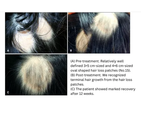(A)Pre-treatment