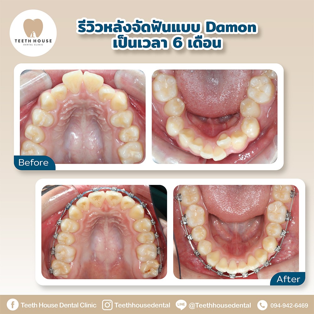 รีวิวจัดฟันดามอน