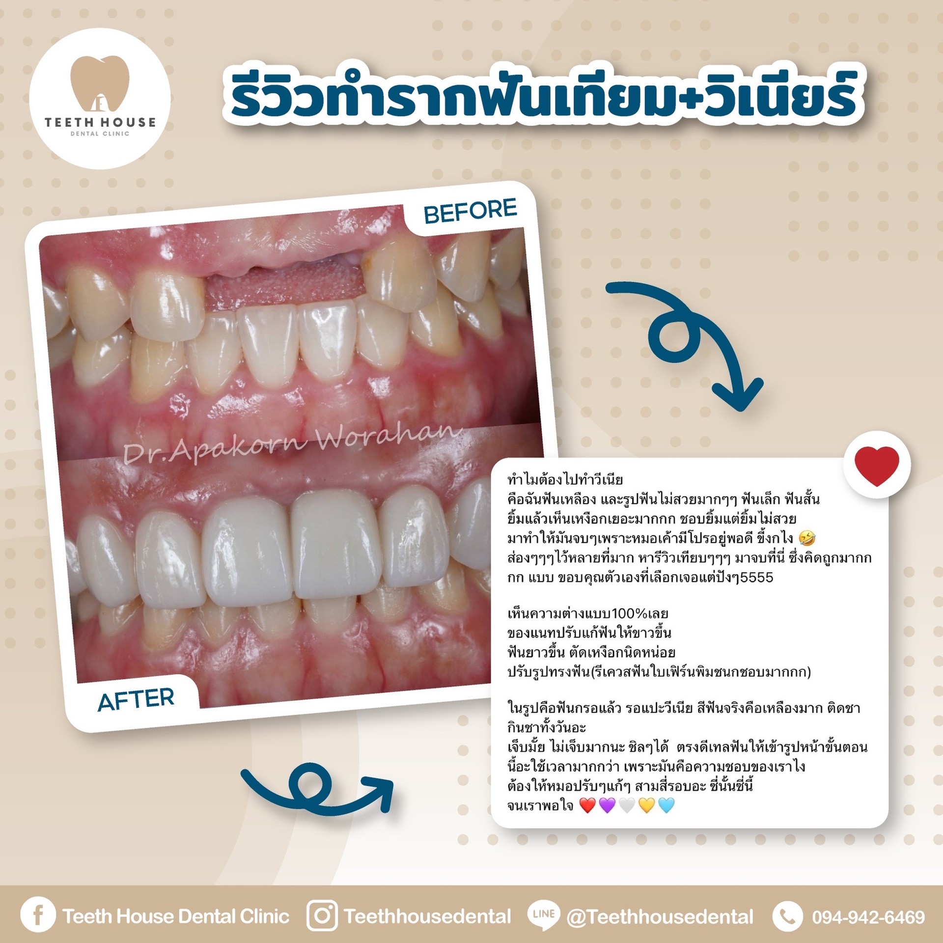 รีวิวทำImplantVeneer