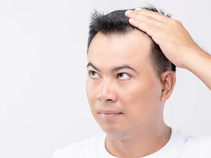 FUE-Long-Hair-เหมาะกับใครบ้าง