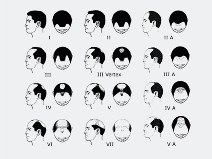 MALE PATTERN HAIR LOSS