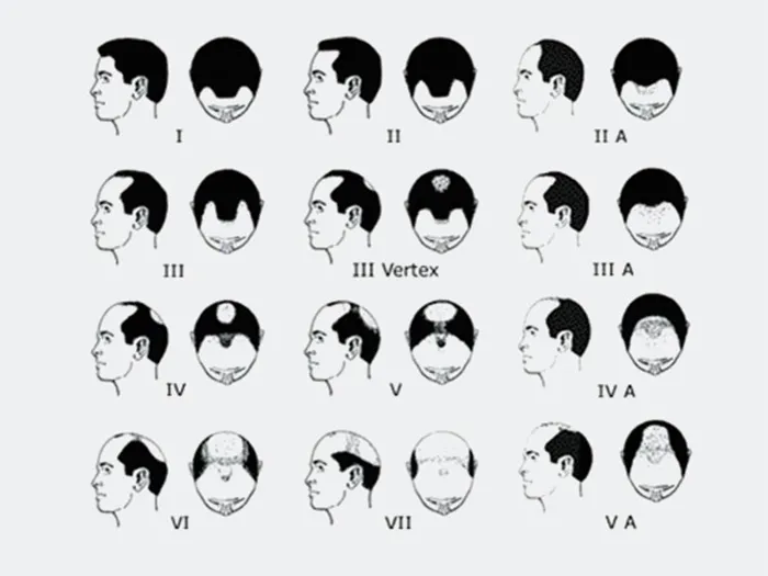 MALE-PATTERN-HAIR-LOSS