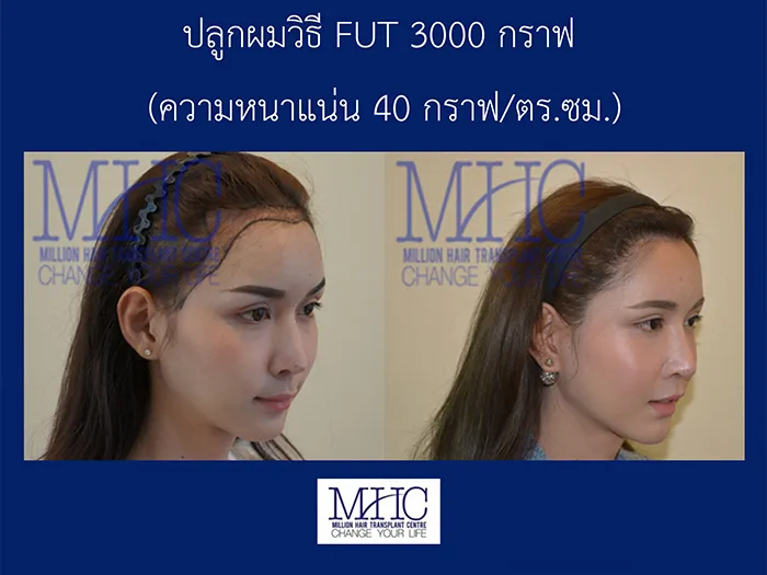 ดูแลต้นกล้าหลังปลูกผม-มีตังอย่างเดียวไม่ได้-วินัยต้องมา