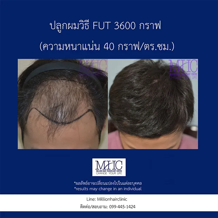 ศัลยกรรมปลุกผมแบบFUT(3)