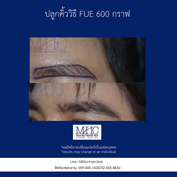 ศัลยกรรมปลูกคิ้ว-หนวด-เครา(1)