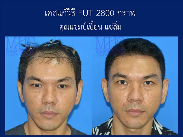 ศัลยกรรมปลูกผมคืออะไร