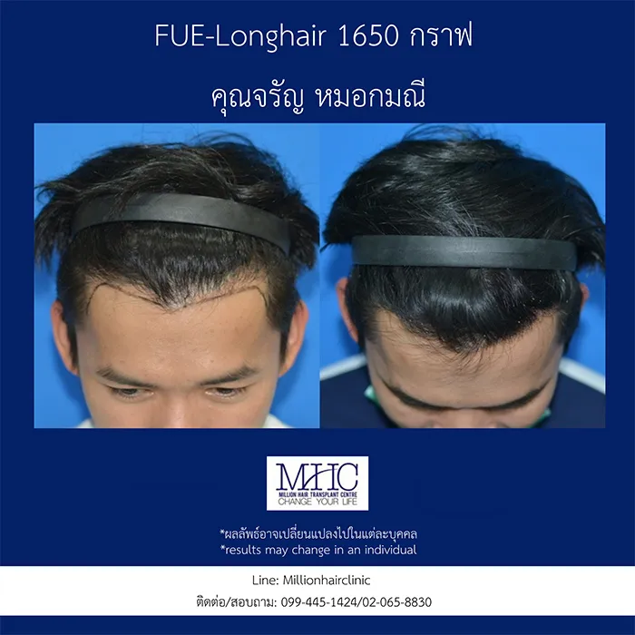 ศัลยกรรมปลูกผมแบบFUE(5)
