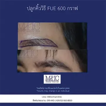 ปลูกคิ้ววิธี-FUT2