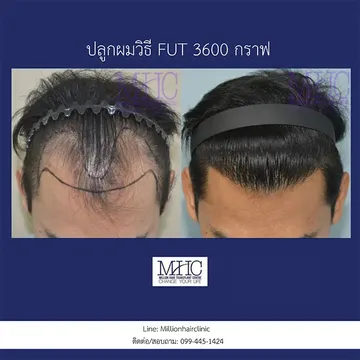 ปลูกผมวิธี-FUT1