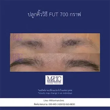ปลูกผมวิธี-FUT3