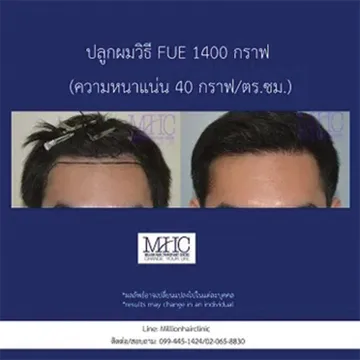 ปลูกผมวิธี-FUT4