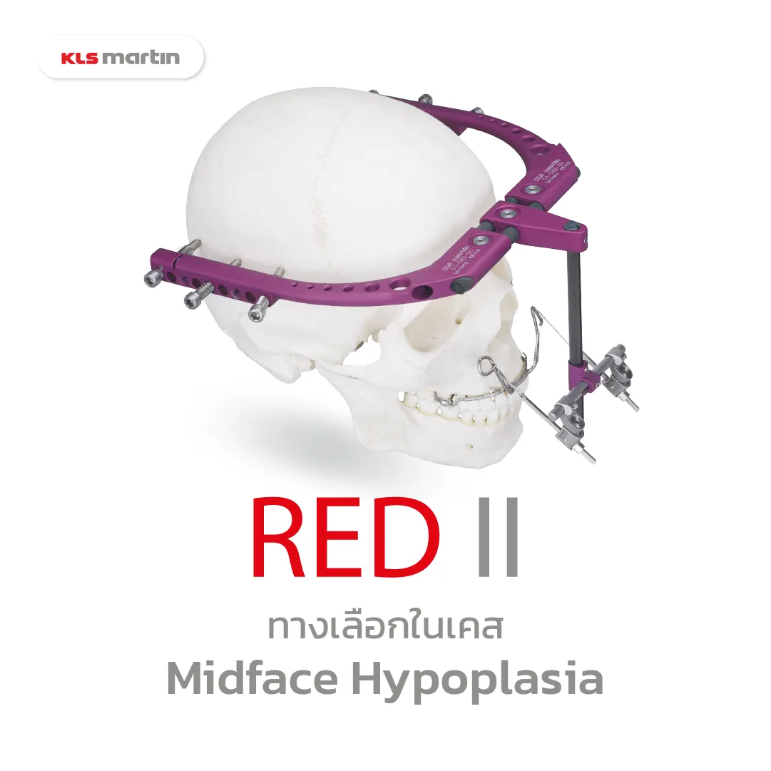 RED2systemทางเลือกในเคสmidfacehypoplasiaรุนแรง-KLSMartin