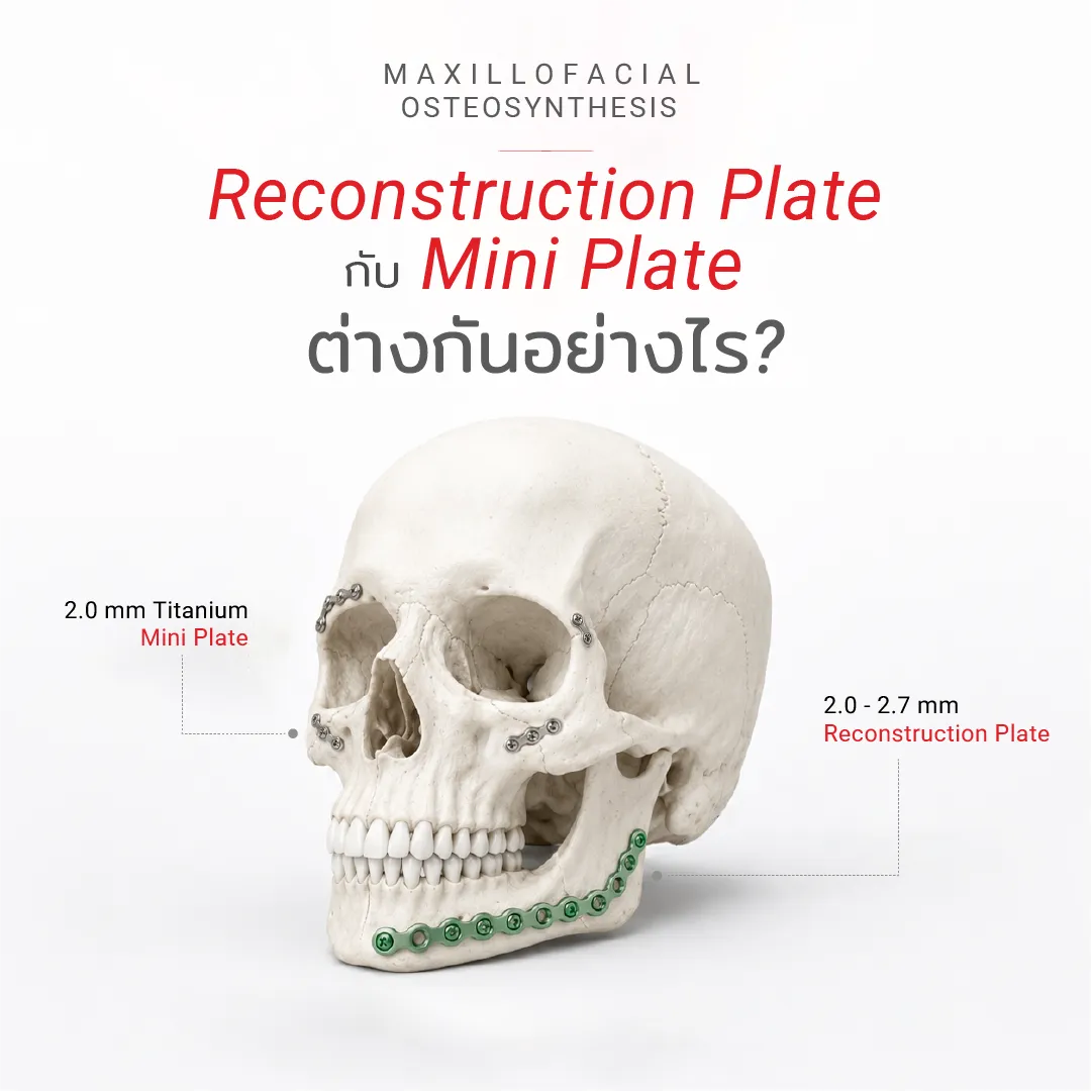 Reconstructionplatevstitaniumminiplate-KLSMartin