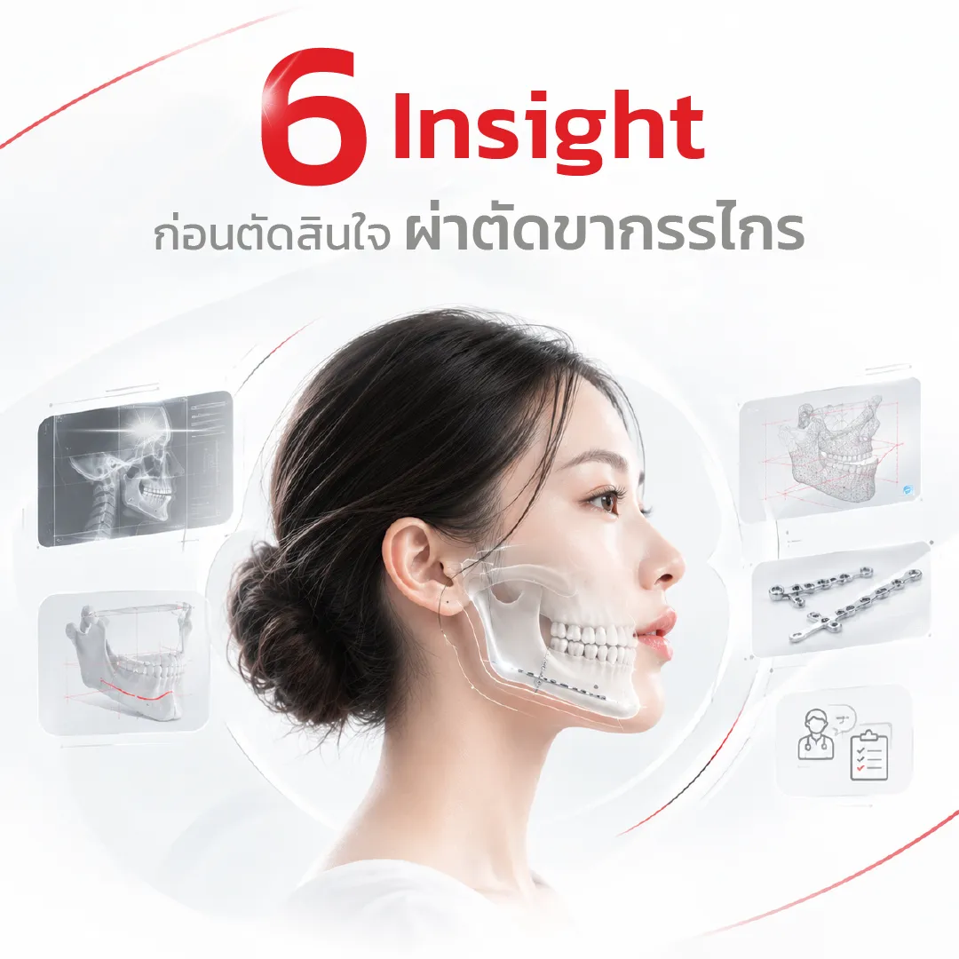 Thumbnail-6Insightควรรู้ก่อนตัดผ่าตัดขากรรไกร-KLSMartin