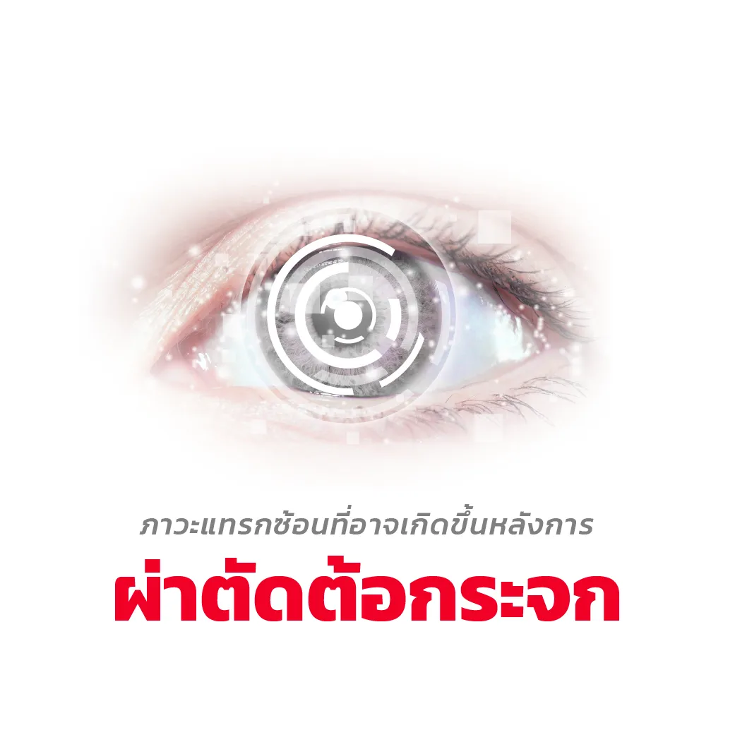 ภาวะแทรกซ้อนที่อาจเกิดขึ้นหลังการผ่าตัดต้อกระจก-เครื่องมือผ่าตัดตาKatena-thumbnail