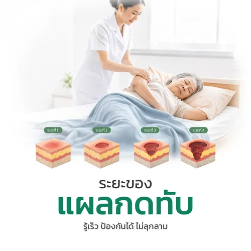 แผลกดทับมีกี่ระยะ-หมอนป้องกันแผลกดทับoasis1188575146003