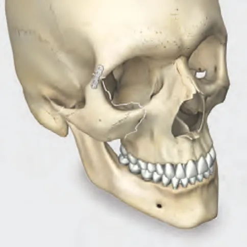 กระดูกใบหน้าส่วนกลางหัก - KLS Martin