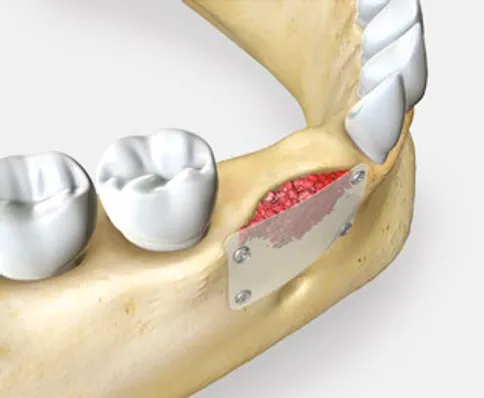 ปลูกกระดูกฟัน (Bone Grafting) - KLS Martin