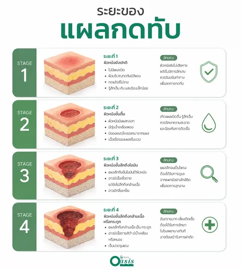 ระยะของแผลกดทับ - หมอนป้องกันแผลกดทับ จัดท่าผ่าตัด Oasis - web