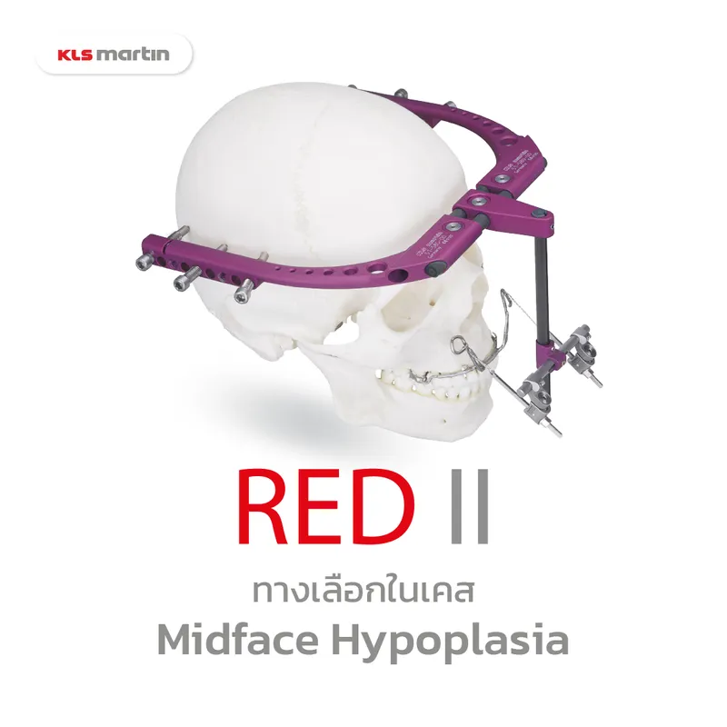 RED 2 system ทางเลือกในเคส midface hypoplasia รุนแรง - KLS Martin