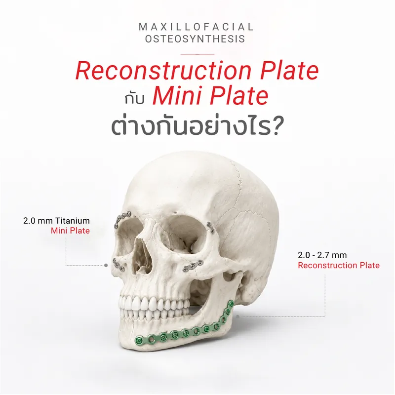 Reconstruction plate vs titanium mini plate - KLS Martin