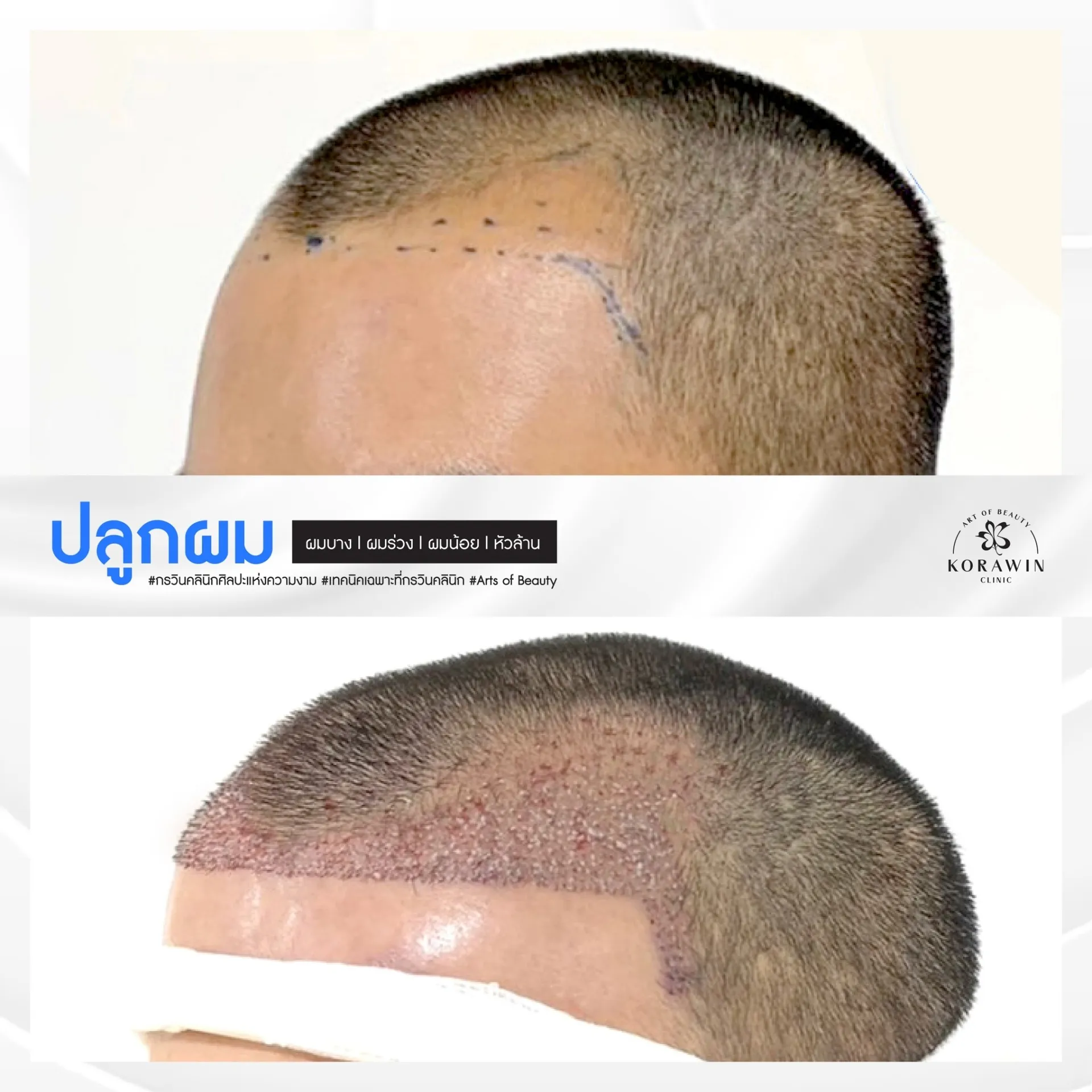 ปลูกผม