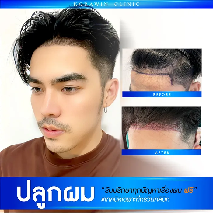 ปลูกผม