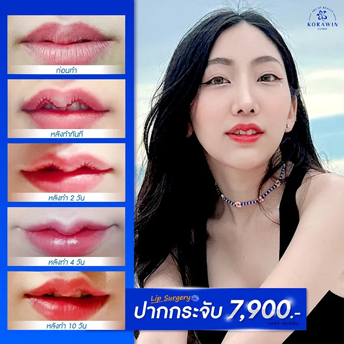 ปากกระจับ