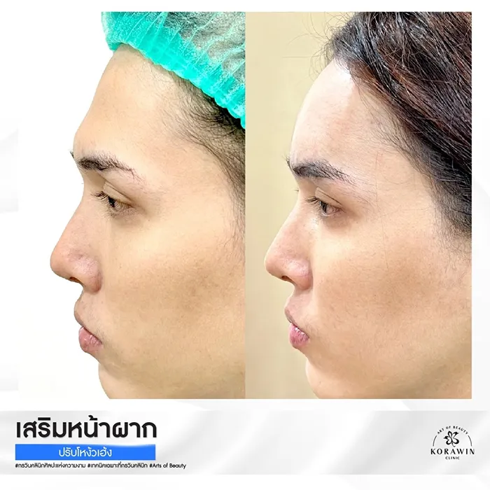 เสริมหน้าผาก