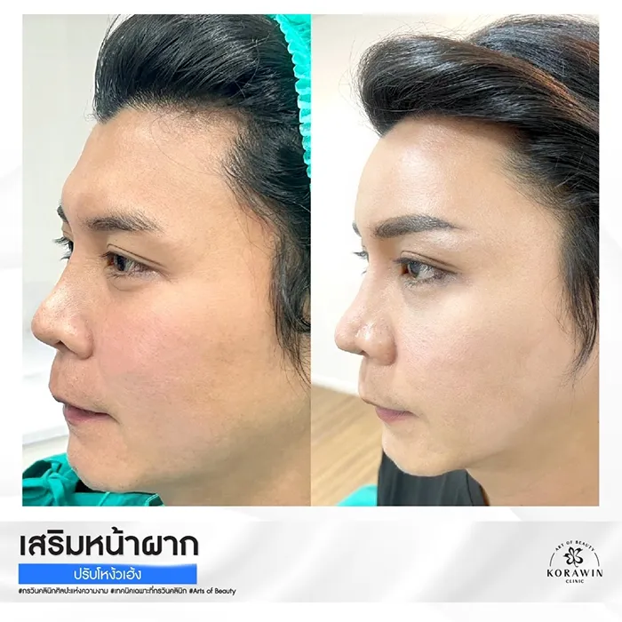 เสริมหน้าผาก