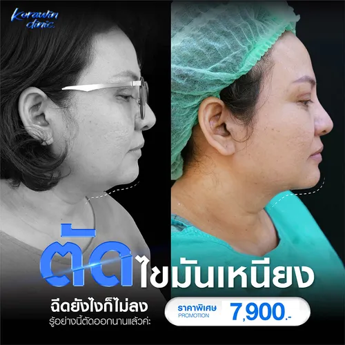 ตัดไขมันเหนียง-01(1)
