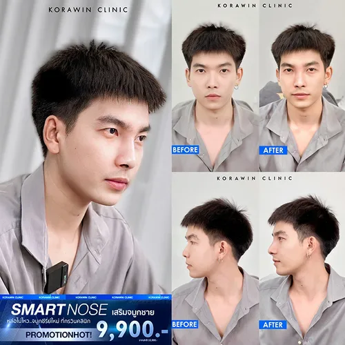 เสริมจมูกทรงSmartnose