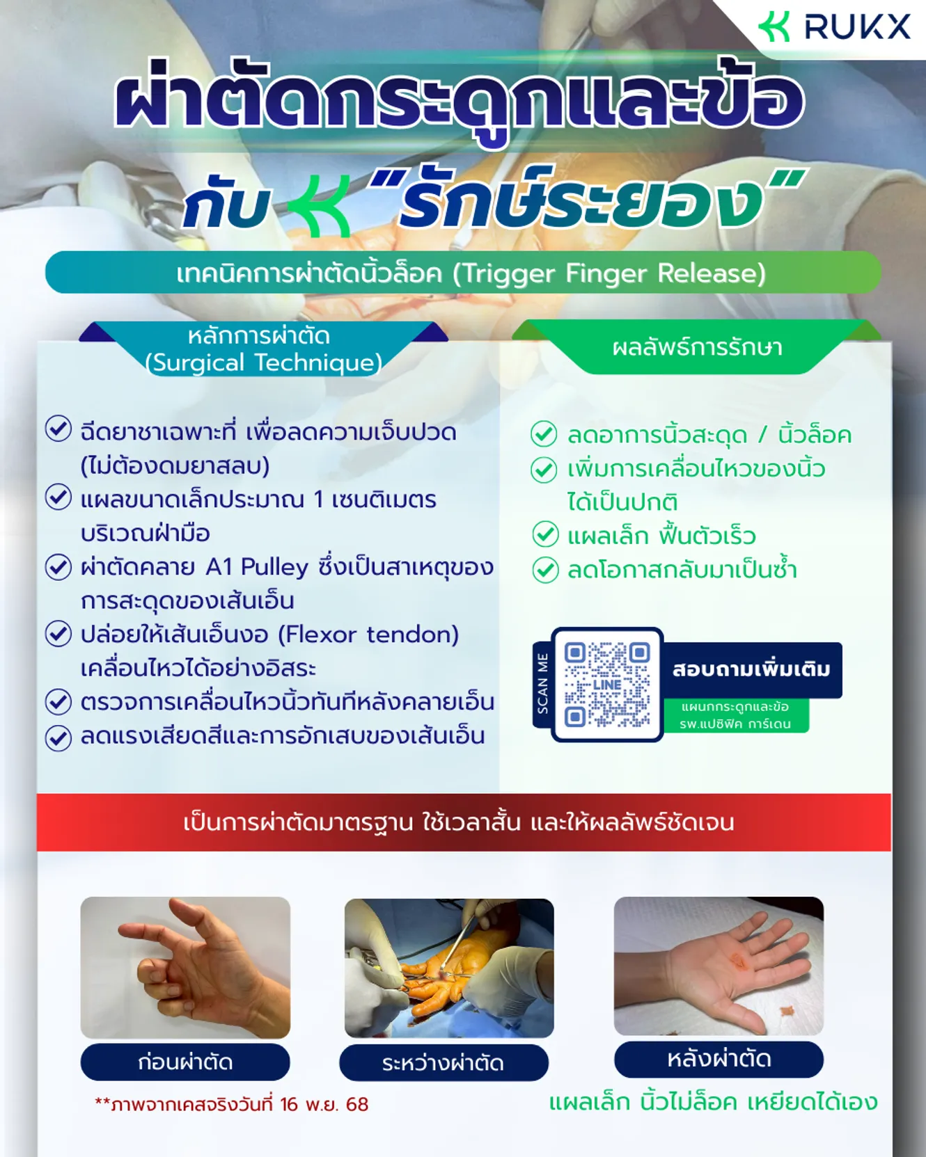Rt Trigger Finger Modifier เทคนิคการผ่าตัดนิ้วล็อค (Trigger Finger Release)