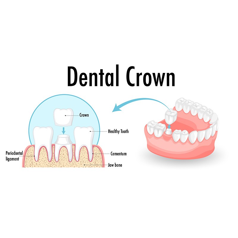 Dental Crowns 