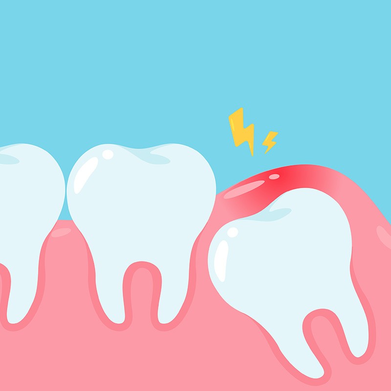 Wisdom tooth surgery - implanted tooth surgery